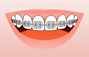 Baraces on teeth example having it brushed