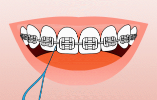Baraces on teeth example having it flossed
