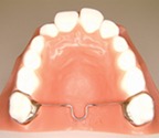 TRANSPALATAL BAR / NANCE / LINGUAL ARCH
