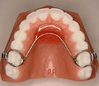 transpalatal bar / Nance