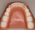 Fixed lingual retainers