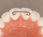 fixed retainer