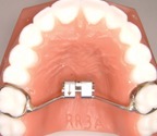 PALATAL EXPANDER