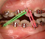 Rubber bands