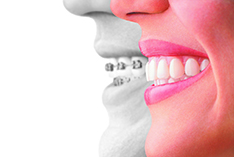 Person smiling with Invisalign