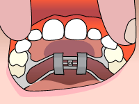 Palatal expander step1