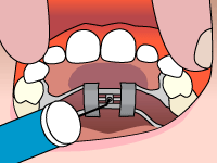 Palatal expander step2