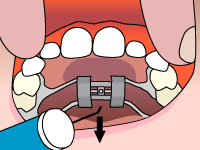 Palatal expander step4