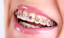 Traditional braces example model